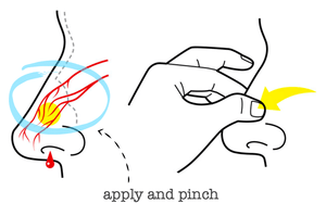 Stop and Prevent Common Nosebleeds