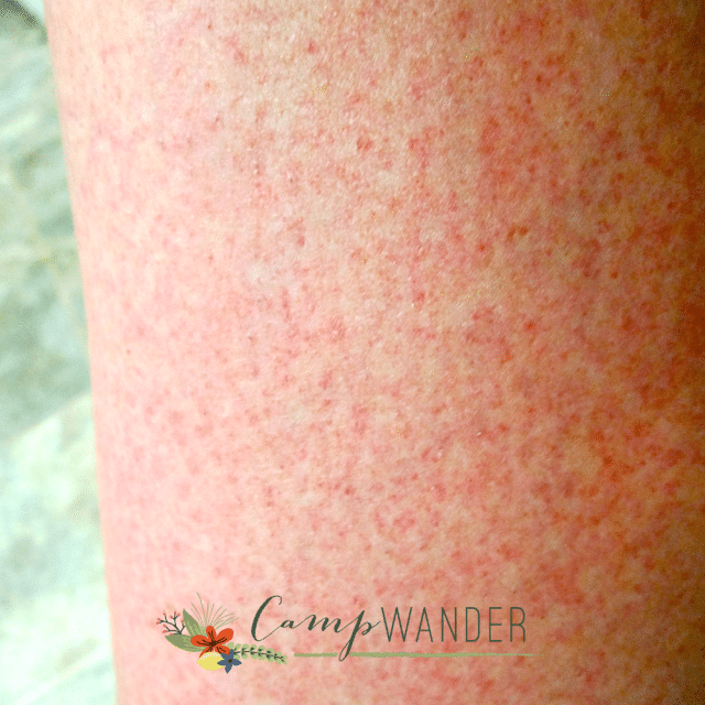 Hello Summer, Goodbye Keratosis Pilaris