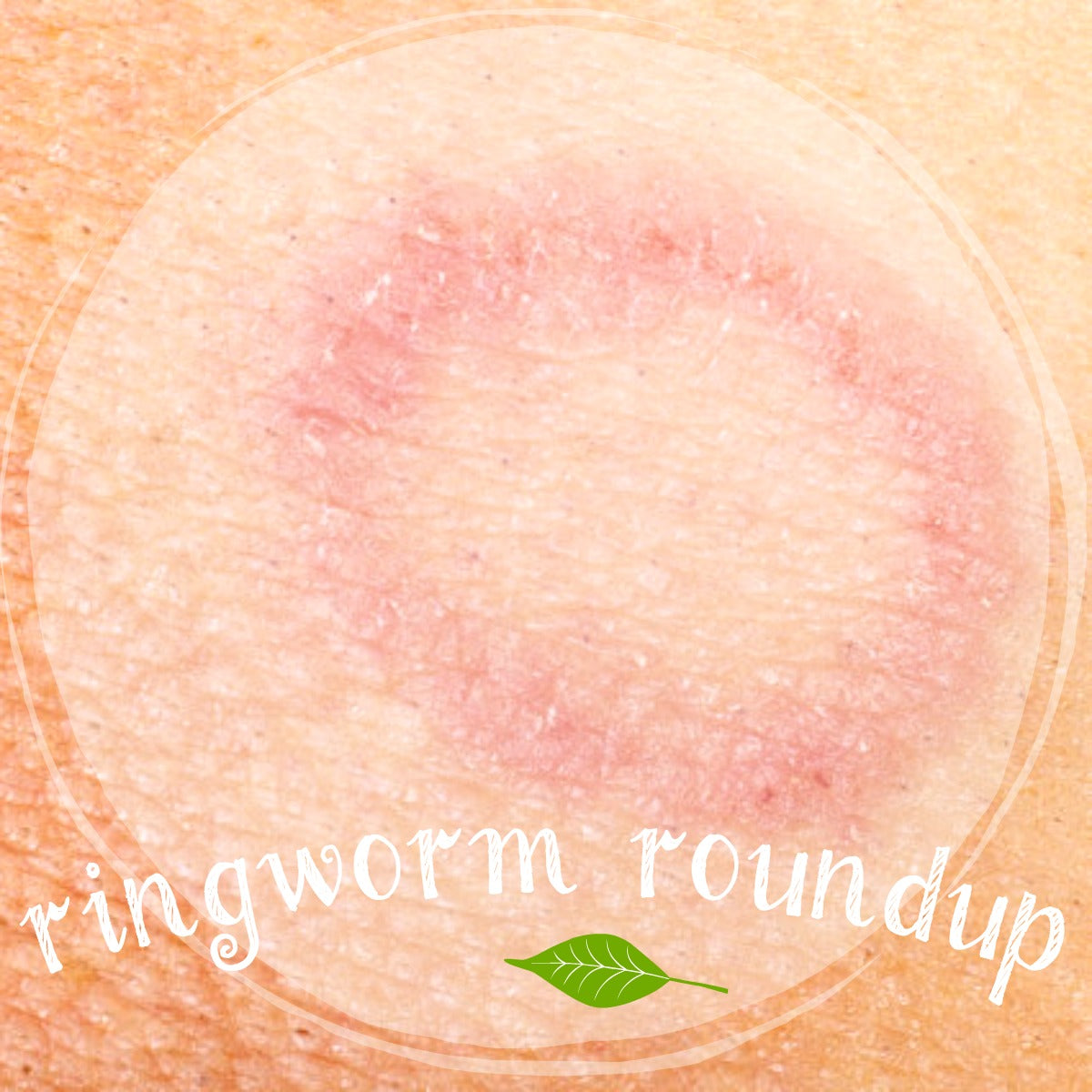 Natural Ringworm Treatment
